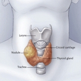 Ablace cystoidů a převážně cystických uzlů alkoholem